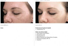 Before and After Dark spots, freckles, hyperpigmentation(melasma or chloasma) on young attractive women - PCA Skin Treatment | Glow Beauty Bar in Smyrna, GA