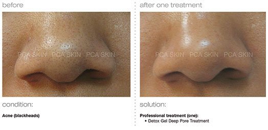 Before and After Acne-blackheads Treatment PCA Skin Nose | Glow Beauty Bar in Smyrna, GA