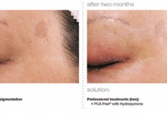 Before and After Dark spots, freckles, hyperpigmentation(melasma or chloasma) on young attractive women - PCA Skin Peel Treatment | Glow Beauty Bar in Smyrna, GA