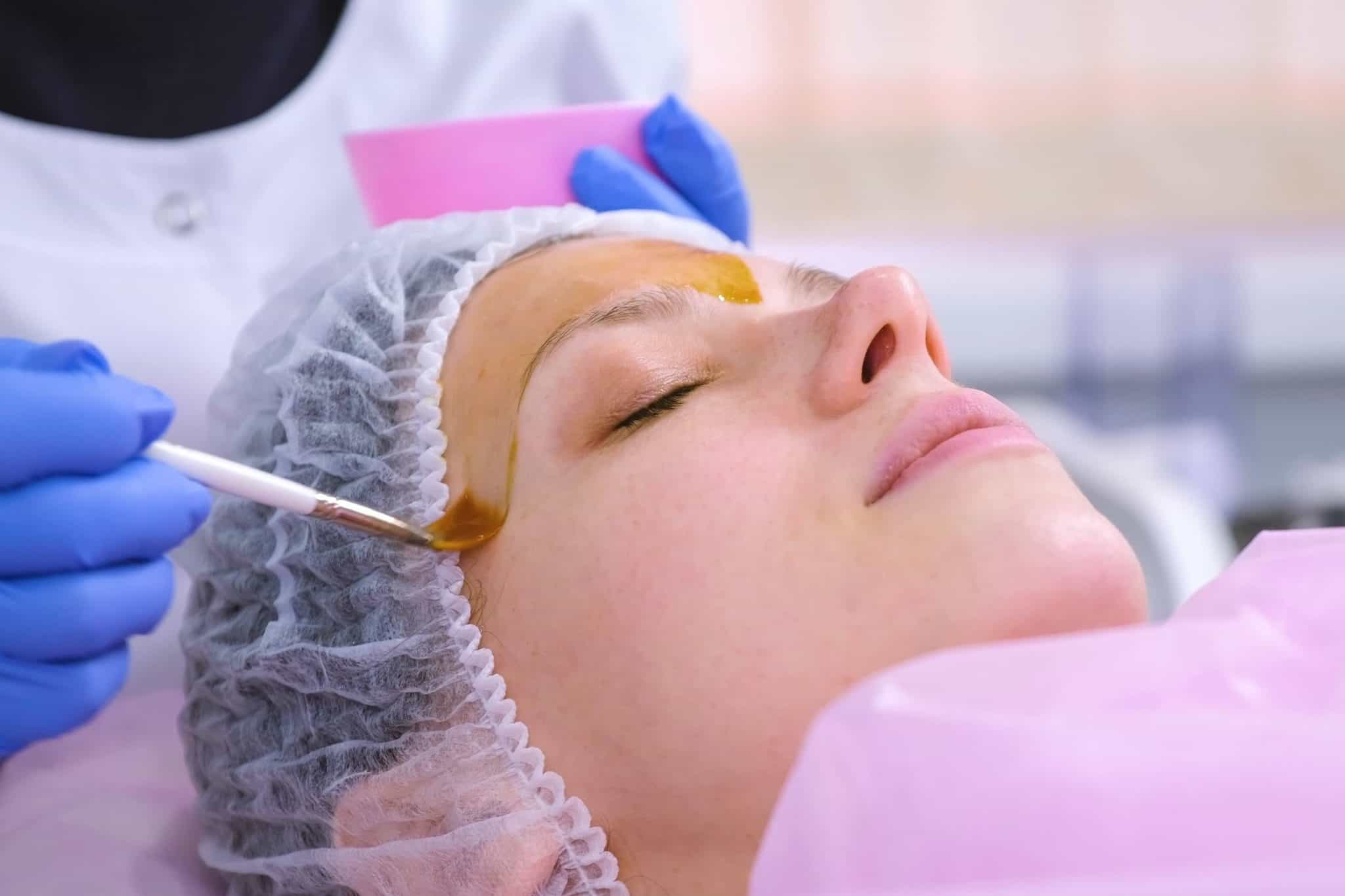 Chemical Peels for Acne: How Effective Are They